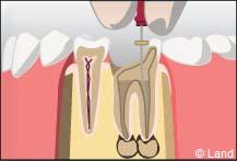 traitement radiculaire