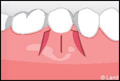 Chirurgie mucogingivale