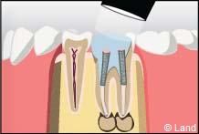 traitement radiculaire